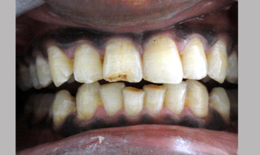 Cosmetic dentistry treatment in Anand
                        